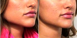 Dr Nima Shemirani, MD, Beverly Hills Facial Plastic Surgeon - 32 Year Old Woman Treated With Botox
