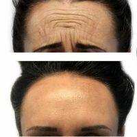 Dr Stephen M. Becker, Knoxville Plastic Surgeon Botox Shots In Forehead