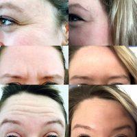 Dr Stephen M. Lazarus, Knoxville Plastic Surgeon Botox Injection Results