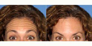 Dr. Anita Patel, MD, FACS, Beverly Hills Plastic Surgeon - 39 Year Old Woman Treated With Botox