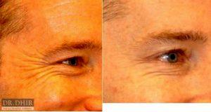 Dr. Karan Dhir, MD, Beverly Hills Facial Plastic Surgeon - 43 Year Old Man Treated With Botox Crows Feet