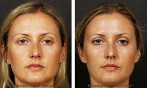 Dysport Treatment By Dr. Rebecca Fitzgerald,M.D.,Beverly Hills