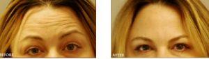 Dysport Was Used To Treat The Frown, Forehead Wrikles By Dr. Mashhadian,M.D.,Beverly Hills
