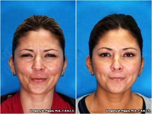 Elemination Glabellar Wrinkles With Botox Injections By Gregory W. Pippin, M.D., F.A.A.C.S.,New Orleans