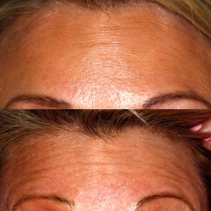 Forehead Before And After Botox At Canatella Dental General & Cosmetic Dentistry,New Orleans