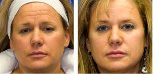 Forehead Botox Combined With Forehead Radiesse Filler By Dr. Lampert,Seattle