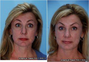 Forehead Line Eleminations With Botox By Gregory W. Pippin, M.D., F.A.A.C.S.,New Orleans