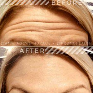 Forehead Lines Correction By George Gavrila, MD,Baltimore