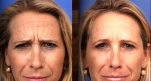 Forehead Lines Correction With Botox Cosmetic At Lasky Aesthetics Clinic, Beverly Hills