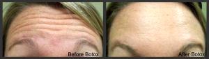 Forehead Lines Treated With Botox By Dr. Marilyn Pelias, M.D,New Orleans