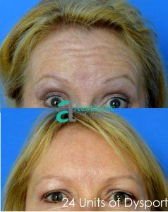 Forehead Wrinkles Correction With Botox By Brittany Lane White RN, MSN, ARNP, FNP-C,Orlando