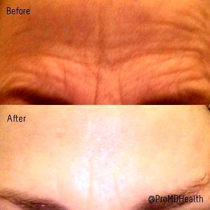 Forehead Wrinkles Treated With Botox By George Gavrila, MD,Baltimore