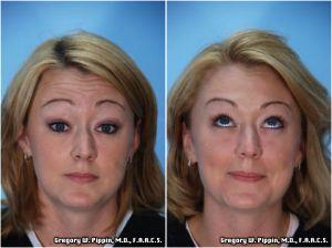 Forehead Wrinkles Treated With Botox By Gregory W. Pippin, M.D., F.A.A.C.S.,New Orleans