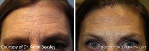 Forehead Wrinkles Treatment With Botox By At The Maryland Dermatology Laser, Skin And Vein Institute,Baltimore