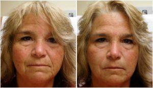Four Syringes Of Restylane Lyft To Soften And Rejuvenate Her Look By Dr. Rottman, MD,Baltimore