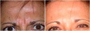 Glabella And Forehead BOTOX Cosmetic. Patient Contracting Muscles In Before And After Photos By Dr. Susie Rhee, M.D.,Orlando