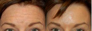 Glabella And Forehead BOTOX. Patient Contracting Muscles In Before And After Photos By Dr. Susie Rhee, M.D.,Orlando