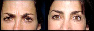 Glabellar Frown Line Correction With Botox By Dr. Schuster's,MD,Baltimore