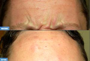 Glabellar Frown Line Correction With Botox Cosmetic By Francis R Palmer III, M.D., F.A.C.S.,Beverly Hills