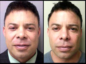 He Underwent Injection Of Juvederm XC To The “parentheses” Around His Mouth By Jeffrey Horowitz, MD,Baltimore
