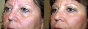 Here Is A 57-year-old Woman Before And After Her Botox And Filler Treatment By Dr. Reath,MD,Knoxville