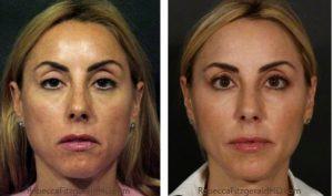 Juvederm, Botox, Restylane, Radiesse By Dr. Rebecca Fitzgerald,M.D.,Beverly Hills