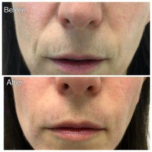 Juvederm Filler Treatment To Achieve Amazing Results Like This Client At NewDermaMed,Toronto