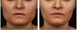 Masseter Reduction With Botox By Dr. Rebecca Fitzgerald,M.D.,Beverly Hills
