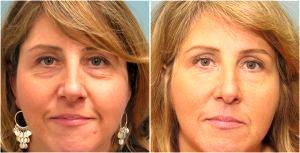 Non Surgical Rejuvenation By Dr. Andre Berger,M.D.,Beverly Hills