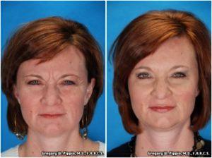 Non-surgical Rejuvenation With Botox Cosmetic By Gregory W. Pippin, M.D., F.A.A.C.S.,New Orleans