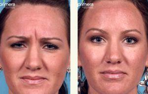 Patients Typically ReceiveBotox Treatment Every 4 Months By Dr. Edward J. Gross,M.D.,Orlando