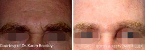 Restylane Injections At The Maryland Dermatology Laser, Skin And Vein Institute,Baltimore