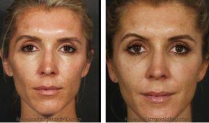 Restylane, Sculptra, Dysport Injections By Dr. Rebecca Fitzgerald,M.D.,Beverly Hills