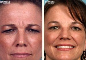 Results 2 Weeks After Botox Treatment To Forehead By Dr. Edward J. Gross,M.D.,Orlando