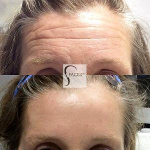 Smooth Out Wrinkles For A More Youthful Appearance With Botox By