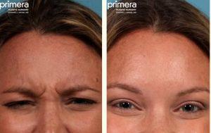 The Creases Between The Eyebrows Relaxes With Botox The Muscle Contraction By Dr. Edward J. Gross,M.D.,Orlando