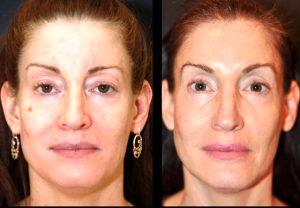 The Patient Had 2 Vials Of Sculptra Over A 5 Week Time Period By Dean P. Kane, MD, FACS,Baltimore
