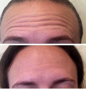 The Patient Treated With Botox Wanted To Smoothing Frown Lines At The Skin Spirit Skin Care Clinic And Spa,Seattle