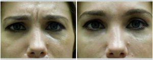 The Patient Underwent Correction Of Tear Trough Depressions With Restylane By Dr. Rottman, MD,Baltimore