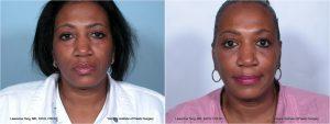 These Photos Show Her Results At 2 Weeks After Injection Of Juvederm Ultra Plus By Dr. Tong, MD,Toronto