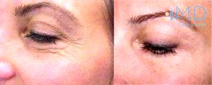 Treatment Crow's Feet With Botox At The Maryland Dermatology Laser, Skin And Vein Institute,Baltimore