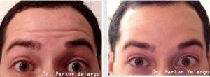 Treatment Of Fine Forehead Wrinkles With Botox By Dr. Parker Velargo, New Orleans