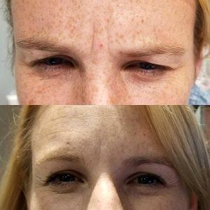 Treatment With Botox At Regenerations Cosmetic Medicine,Knoxville