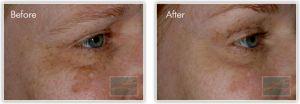 Treatment With Botox Injections By SKYLAR A. SOUYOUL, M.D.,New Orleans