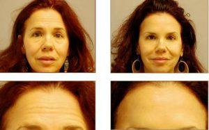 Treatment With Botox To Give Her A Wrinkle Free Appearance By Dr. Mashhadian,M.D.,Beverly Hills