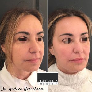 Wrinkle Relaxer Treatment With Botox To Soften The Fine Lines And Crow's Feet, And Dermal Fillers To Treat The Deflation In Her Cheeks And Nasolabial Fold By Dr. Herschorn, MD,Toronto