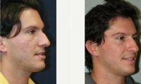 25 Year Old Man Treated With Radiesse Before By Doctor Kris M. Reddy, MD, FACS, West Palm Beach Plastic Surgeon