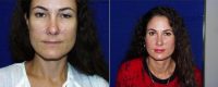 39 Year Old Woman Treated With Juvederm Before By Dr Kris M. Reddy, MD, FACS, West Palm Beach Plastic Surgeon