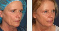 49 Year Old Woman Treated With Radiesse Before By Dr. Douglas Wu, MD, San Diego Dermatologist
