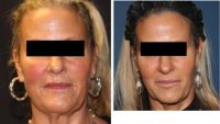 51 Year Old Woman Treated With Radiesse Before By Doctor Marc J. Salzman, MD, FACS, Louisville Plastic Surgeon